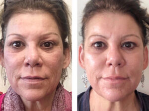 Scarlet-microneedling-before-and-after-photo3 - Integrative Aesthetics